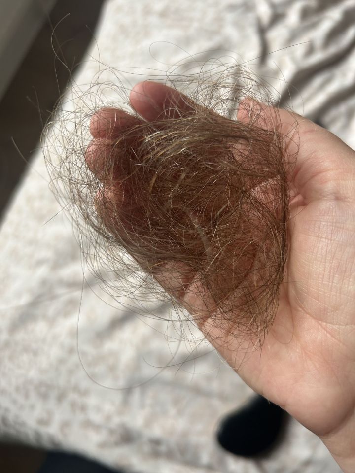 Handful of brown hair lost due to cancer treatment.