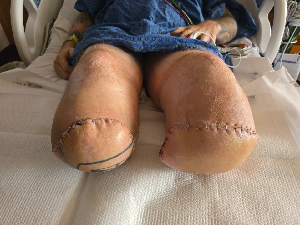 Close-up of a man's legs after a double amputation.