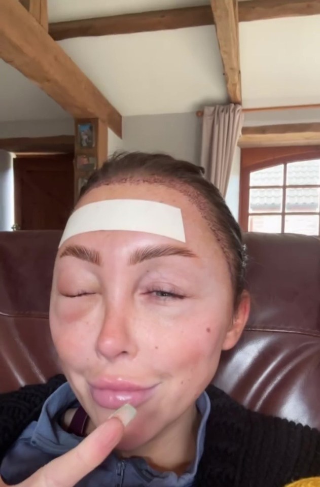 Ella Morgan after a hair transplant, showing swelling.