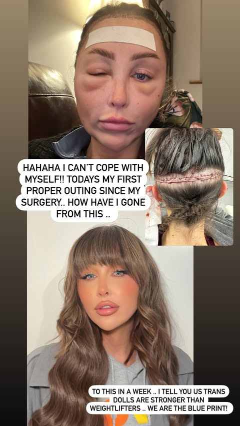 Collage showing a woman's swollen face after surgery, a surgical scar on her head, and her recovered appearance a week later.