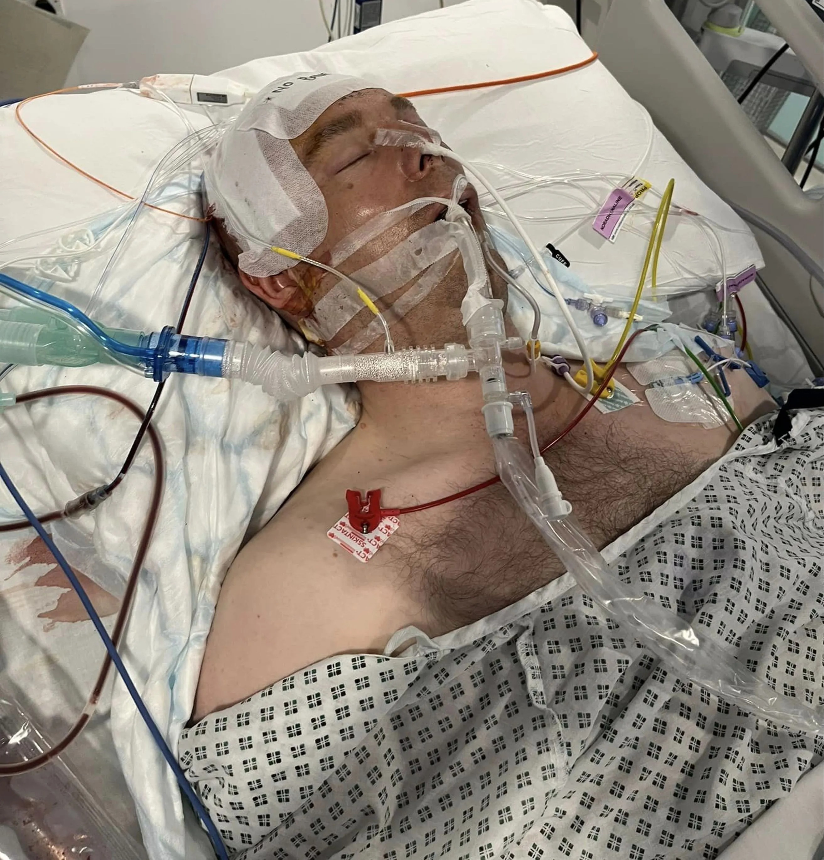 Lee ended up on life support after his stag party