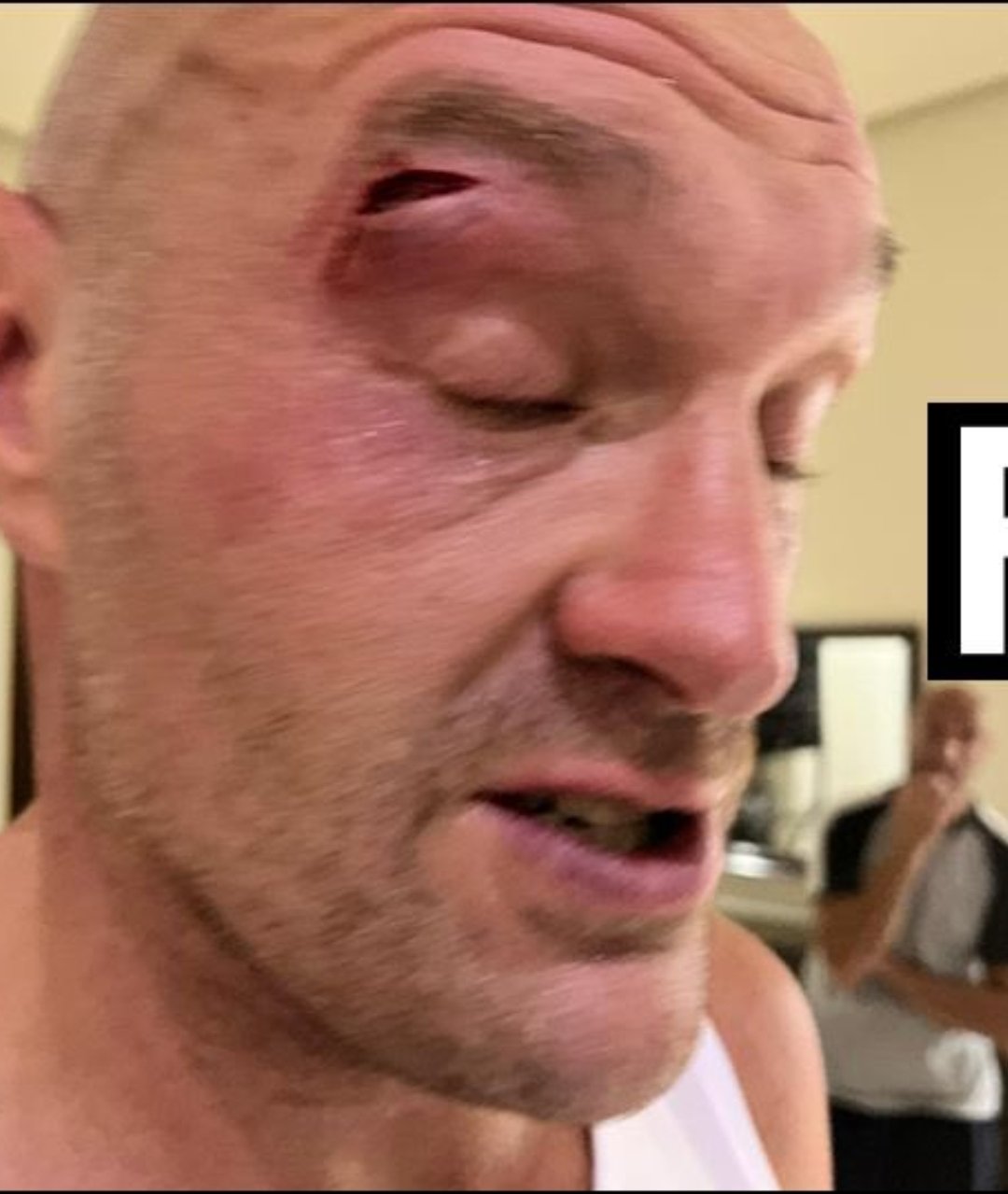 Tyson Fury suffered a cut that postponed the Usyk fight from its original date on February 17