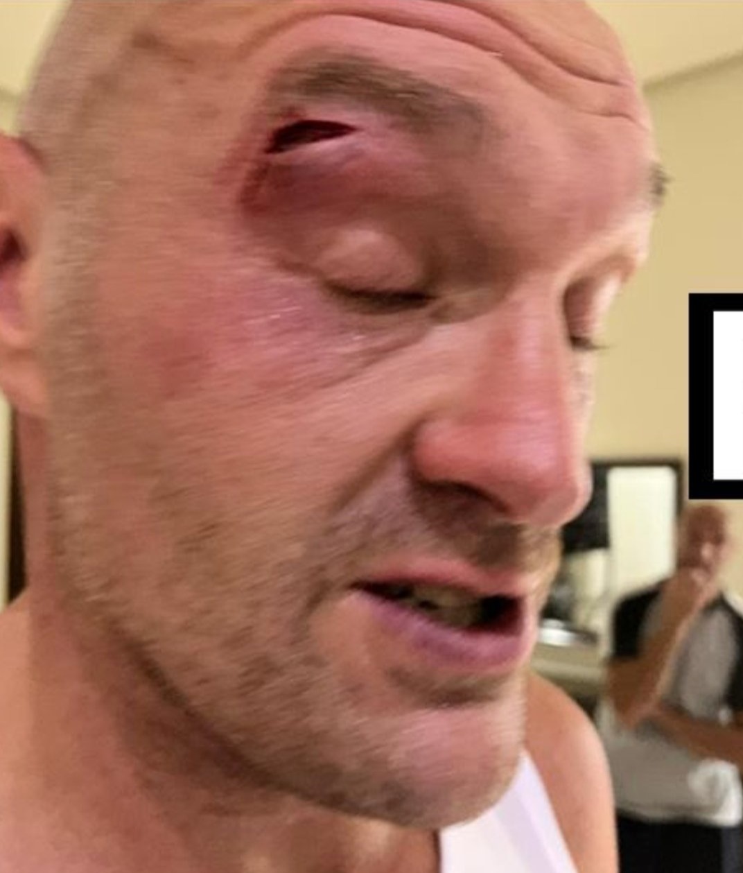 Tyson Fury suffered a cut in a sparring session