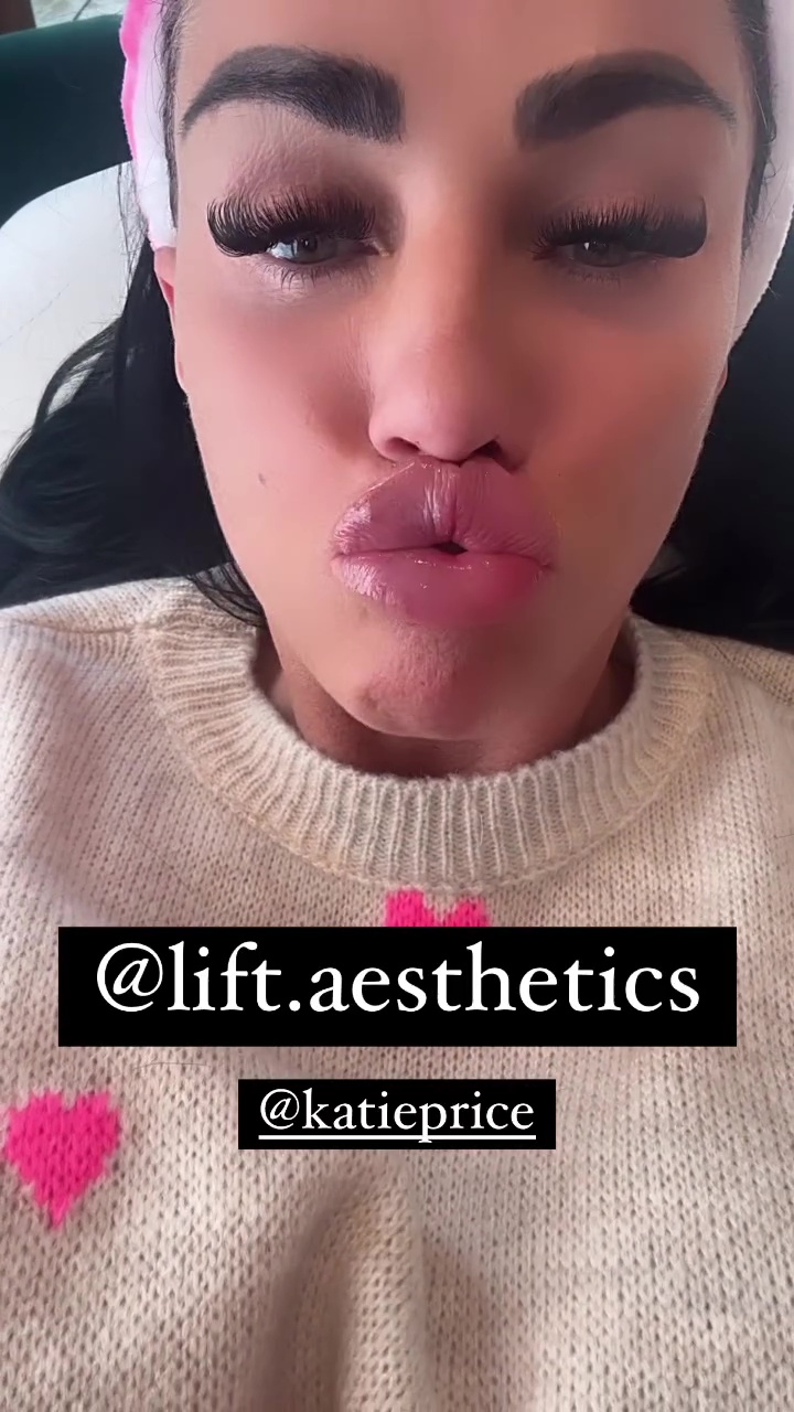 The new lip technique has been publicized by glamour model Katie Price