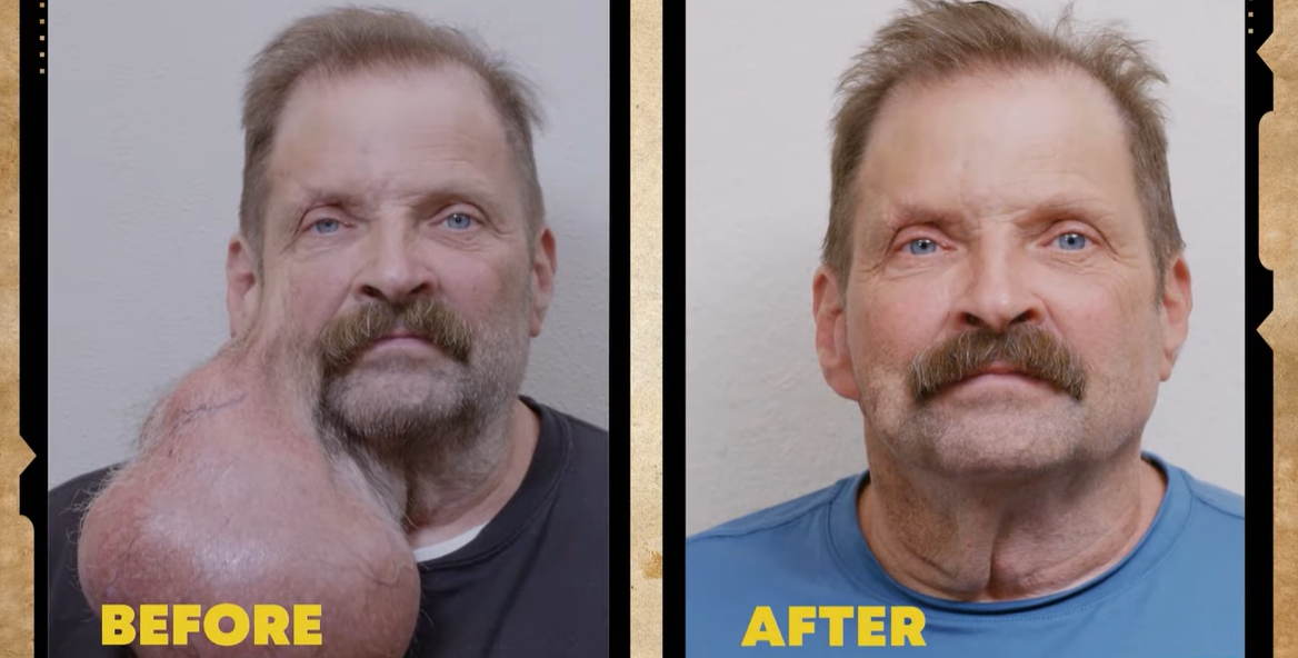 Tim underwent a challenging surgery to remove the growth and now feels "lighter"