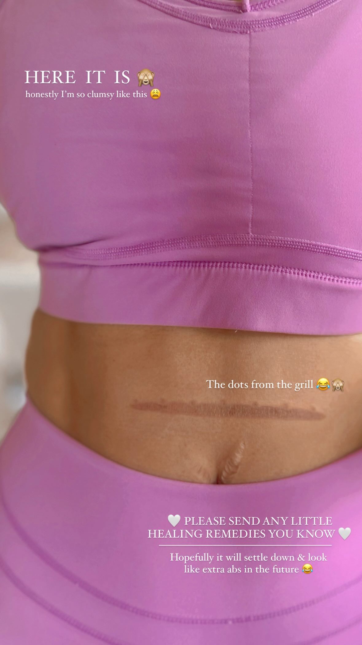 The TV presenter suffered a painful-looking scar on her stomach