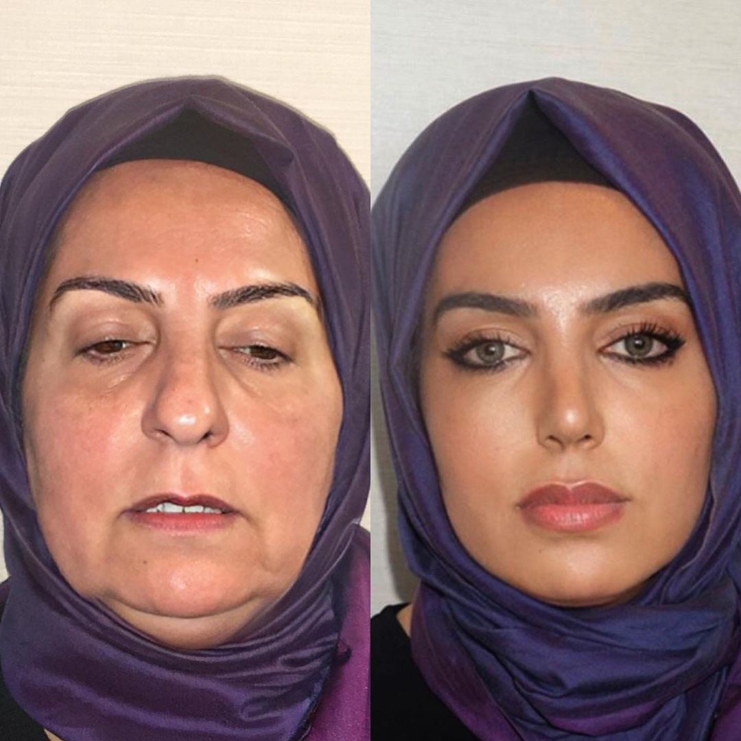 A patient named Miss Dilek looks incredibly different after her alleged 'two years of rhinoplasty face lift and blepheroplasty surgeries'