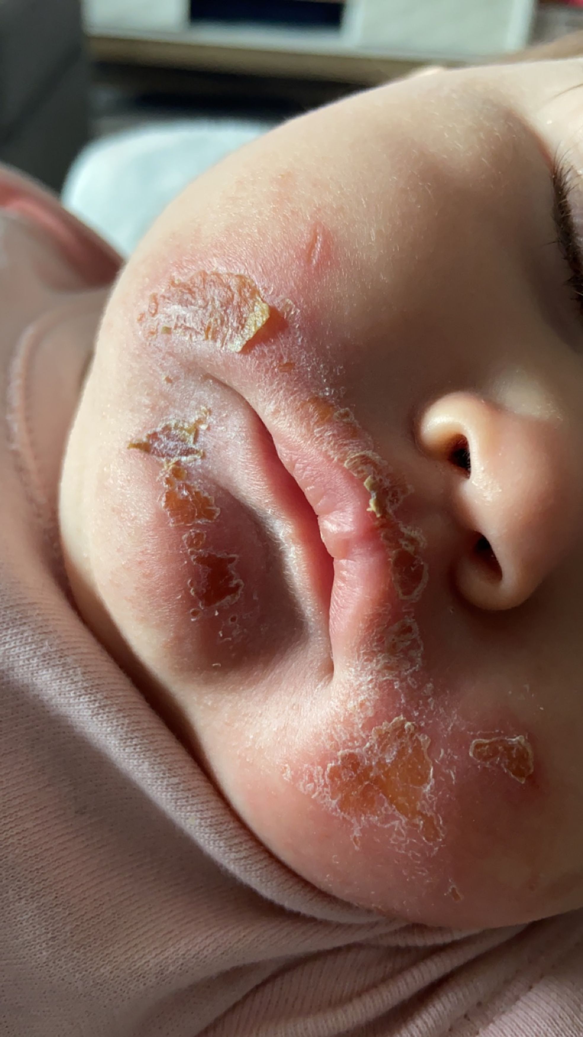 Sap from the veg got onto the tot's skin which made it more sensitive to sunlight