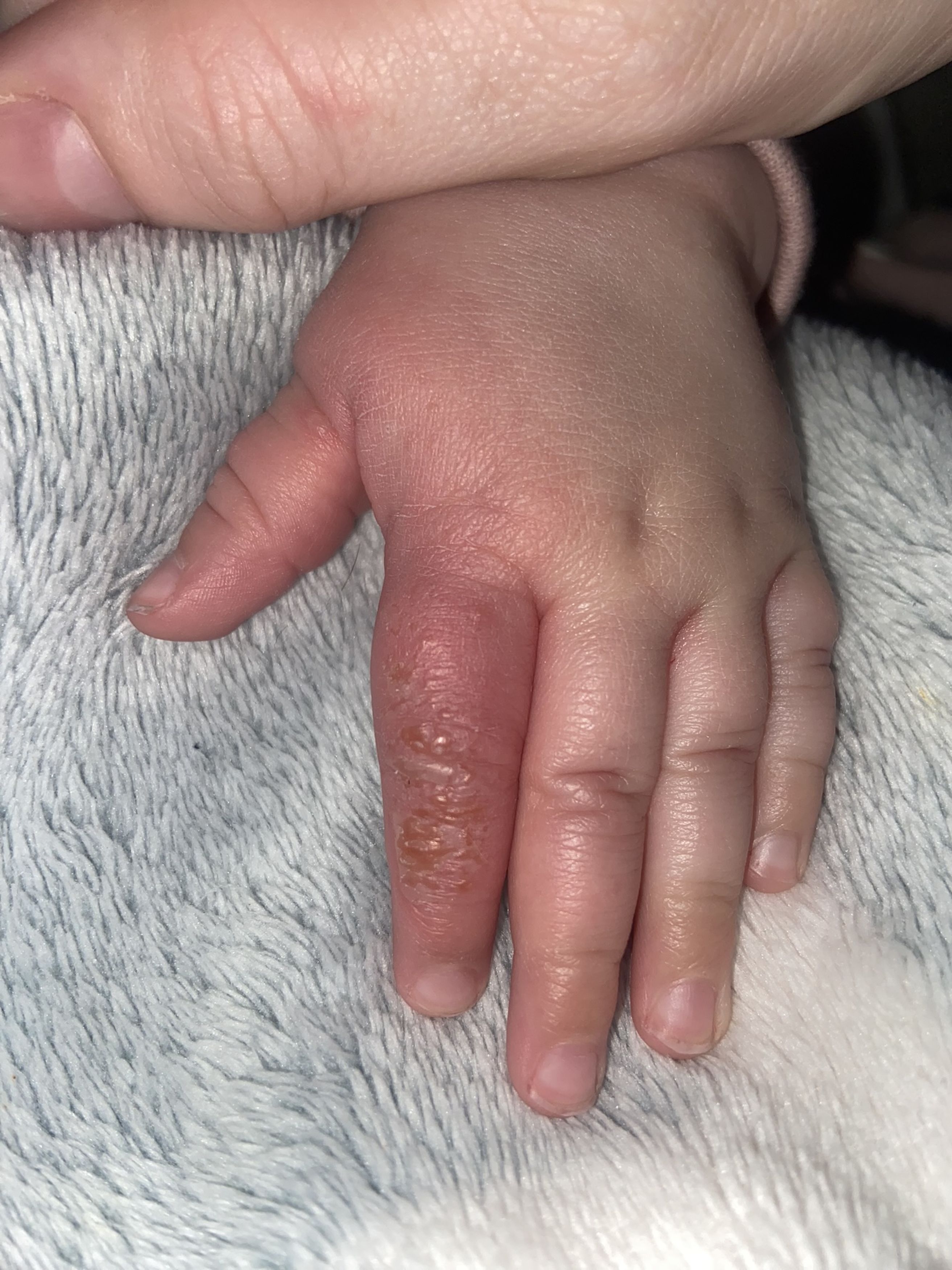 The little one may be scarred for life from the vegetable-induced skin reaction