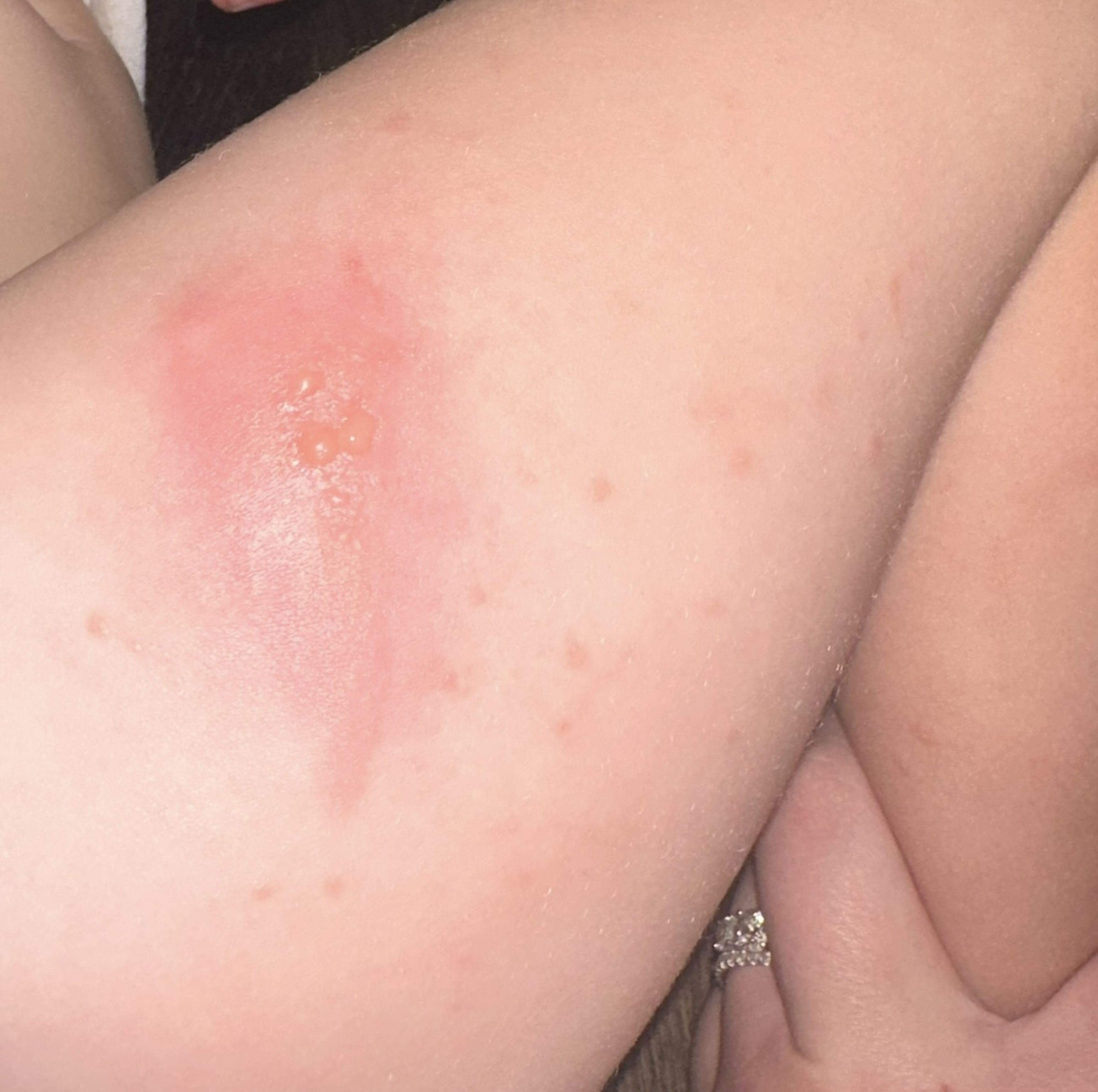 Blisters erupted into large, angry-looking burns all over little Ella's body (Credit: Kennedy News and Media)