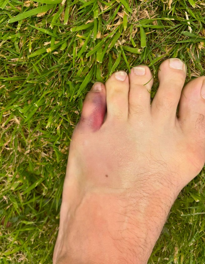 This is the toe injury that forced McGregor out of UFC 303