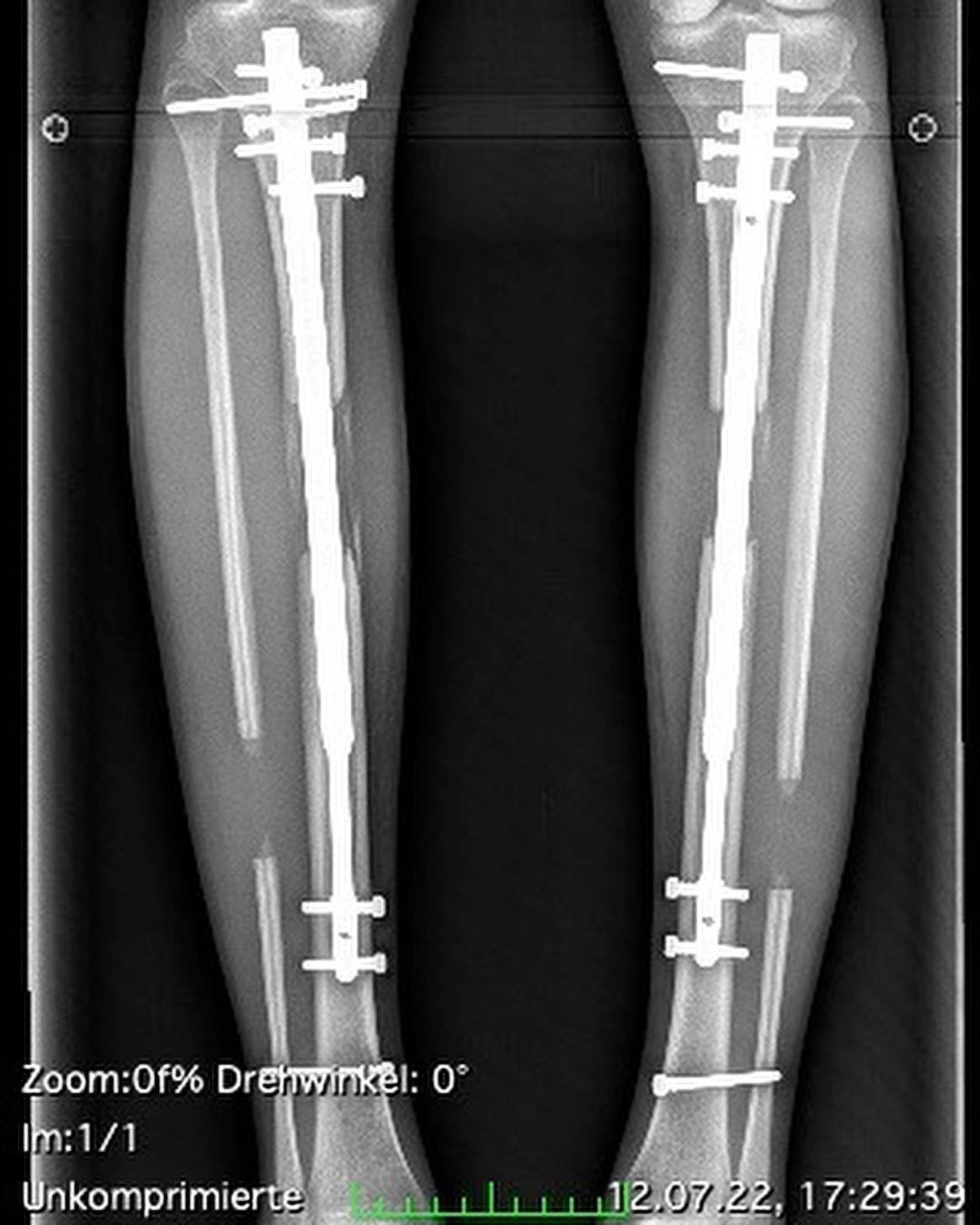 The metal rods inside Theresia's legs have now been removed making her a shocking 6ft tall