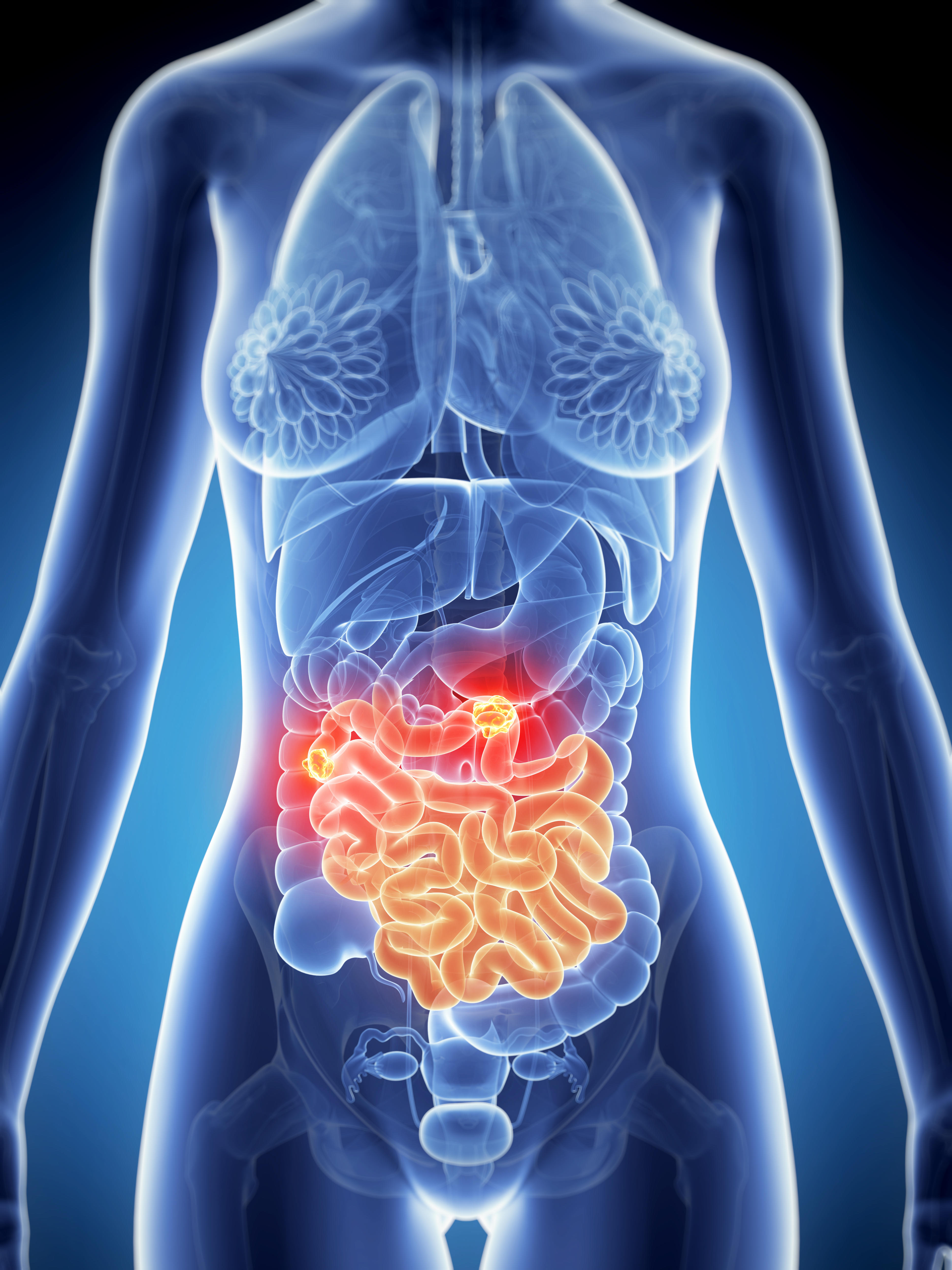 Bowel cancer kills more than 16,800 people every year in the UK