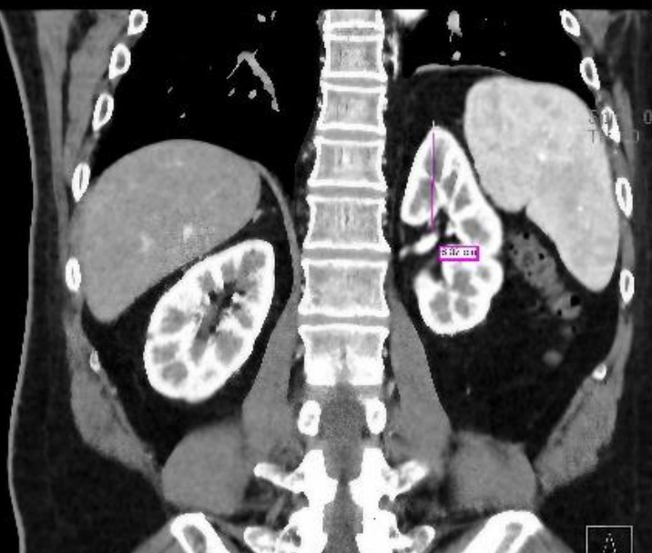 Cheng's right kidney appears 'pushed down'