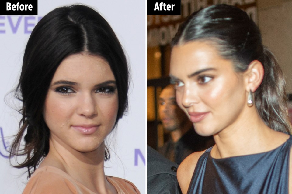 Dr. Harper thinks Kendall has the most natural facial work