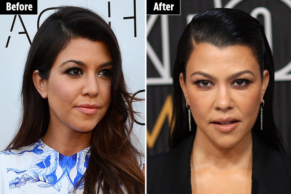 Dr. Harper said Kourtney has fewer wrinkles now than before which isn't natual