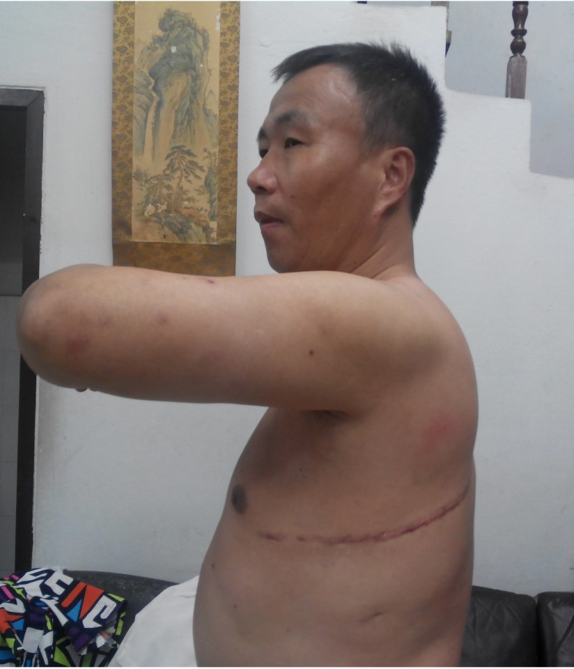 Cheng Pei Ming shows a huge scar he says was from forced surgery