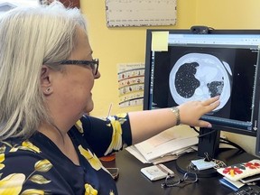 FILE - Dr. Lee Morissette shows an image of lungs damaged by asbestos exposure, April 4, 2024, at the Center for Asbestos Related Disease in Libby, Mont.