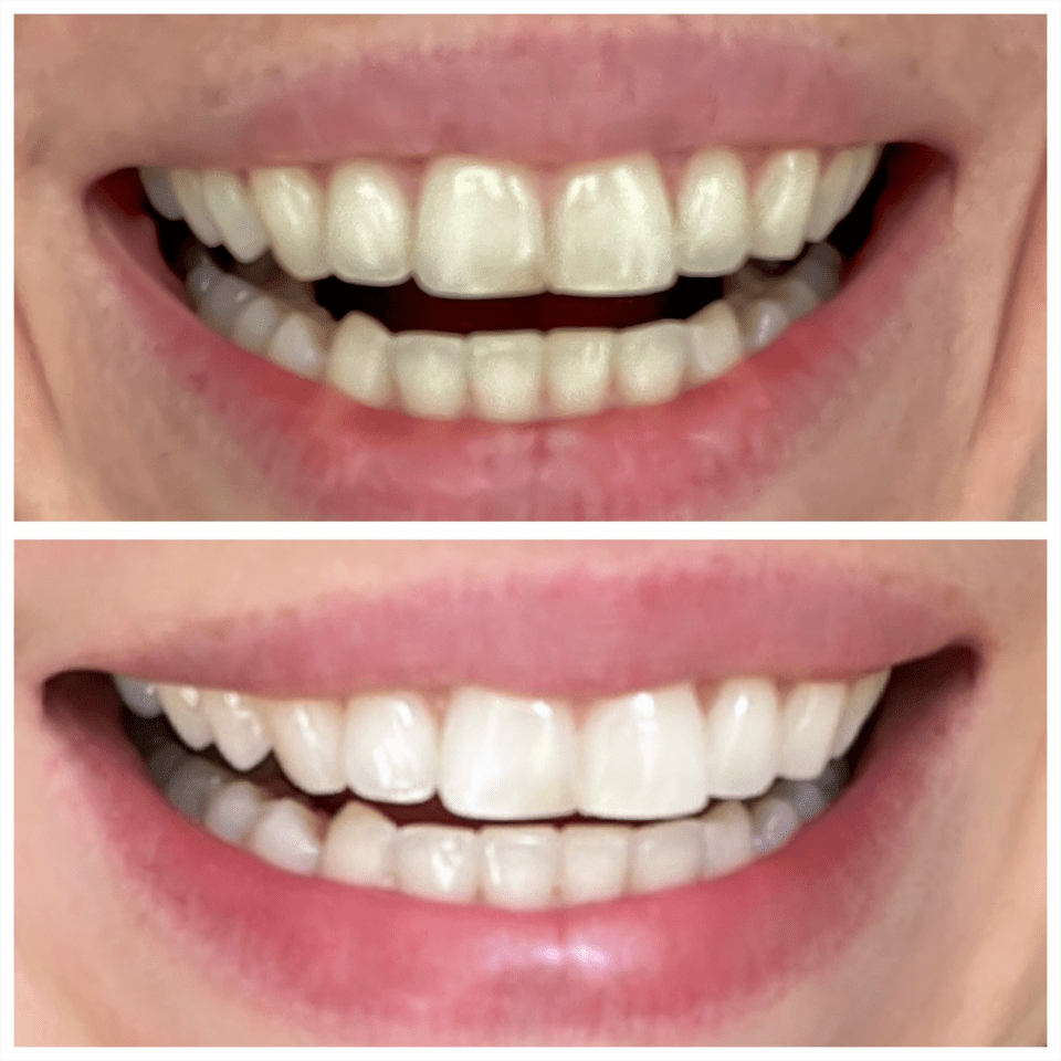 Shoppers noticed results after a few uses of MySweetSmile teeth-whitening powders