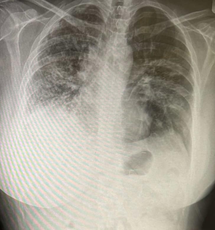 An X-ray of Nicola's lungs show permanent scarring on the lungs