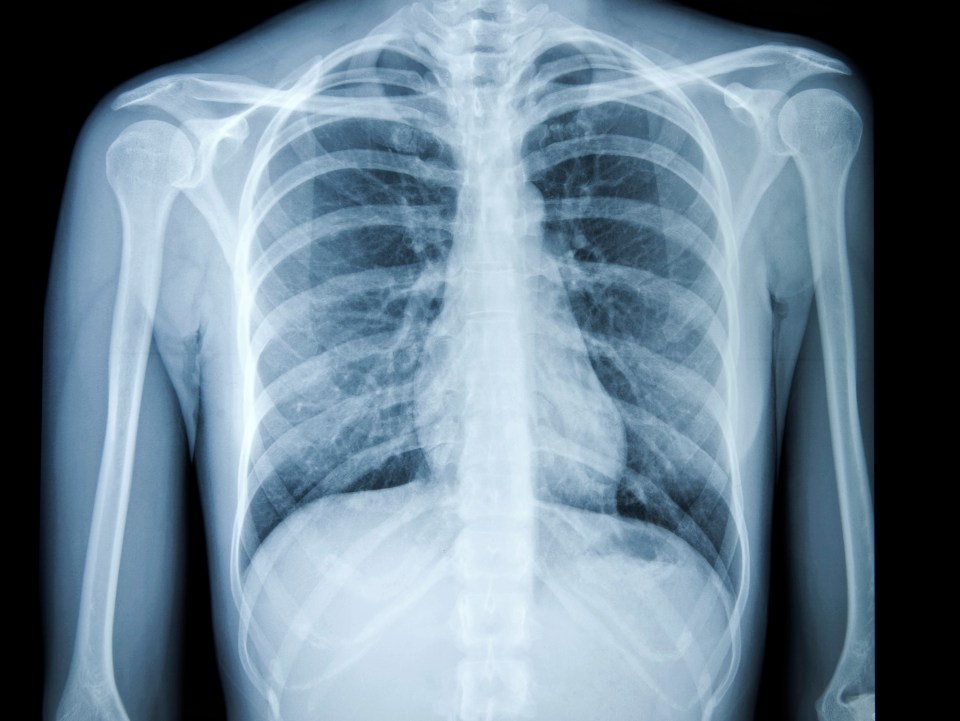 X-ray of healthy lungs (stock image)