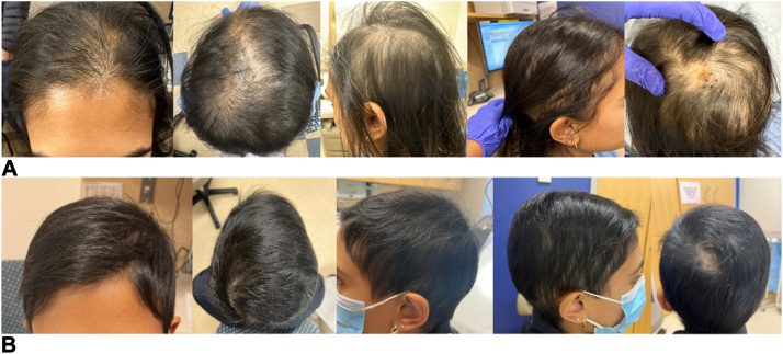 A woman's hair loss after a tick bite - and regrowth after treatment with baricitinib