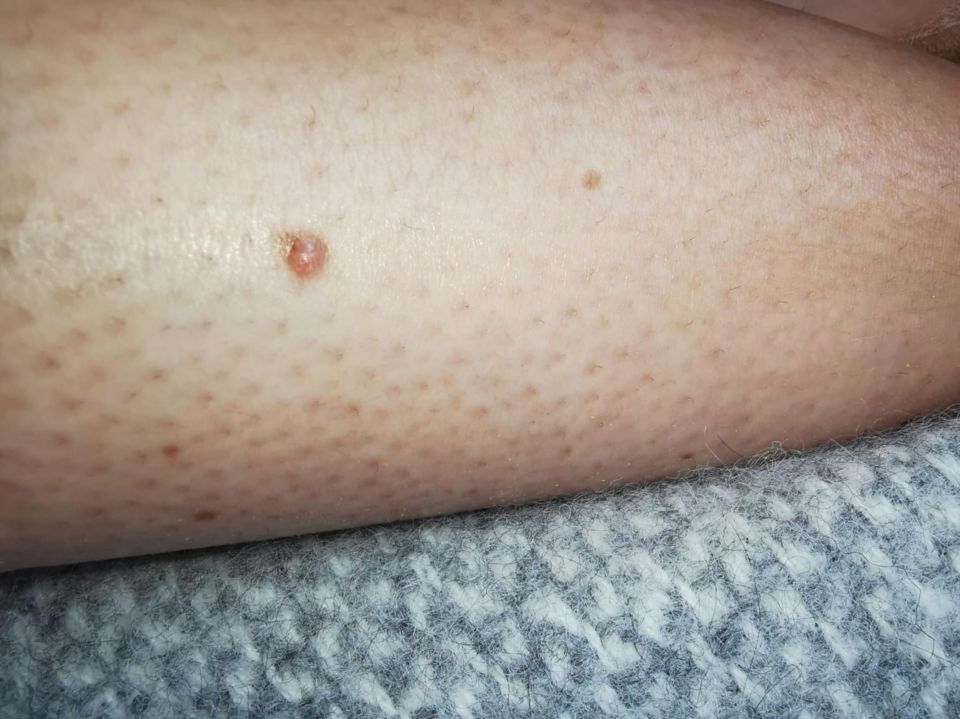 The 38-year-old grew worried when she noticed a mole on her right shin that turned out to be melanoma