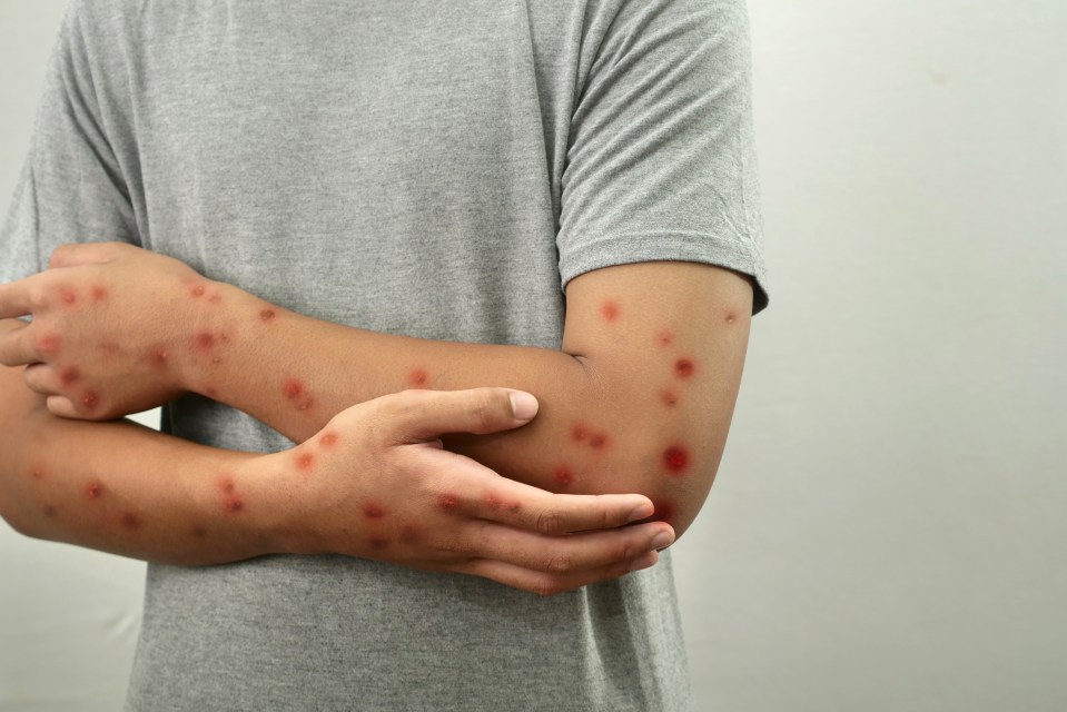 Person's arms with monkeypox lesions.