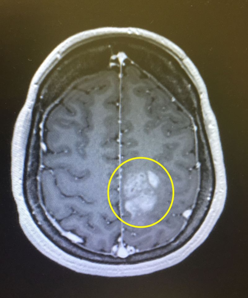 Brain MRI scan showing a tumor.