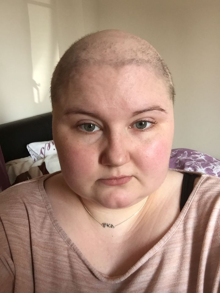 Woman with shaved head during cancer treatment.