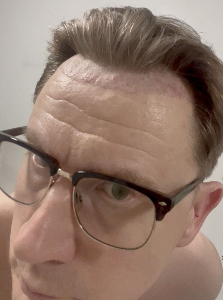 Close-up of a man's forehead showing scarring from a hair transplant.