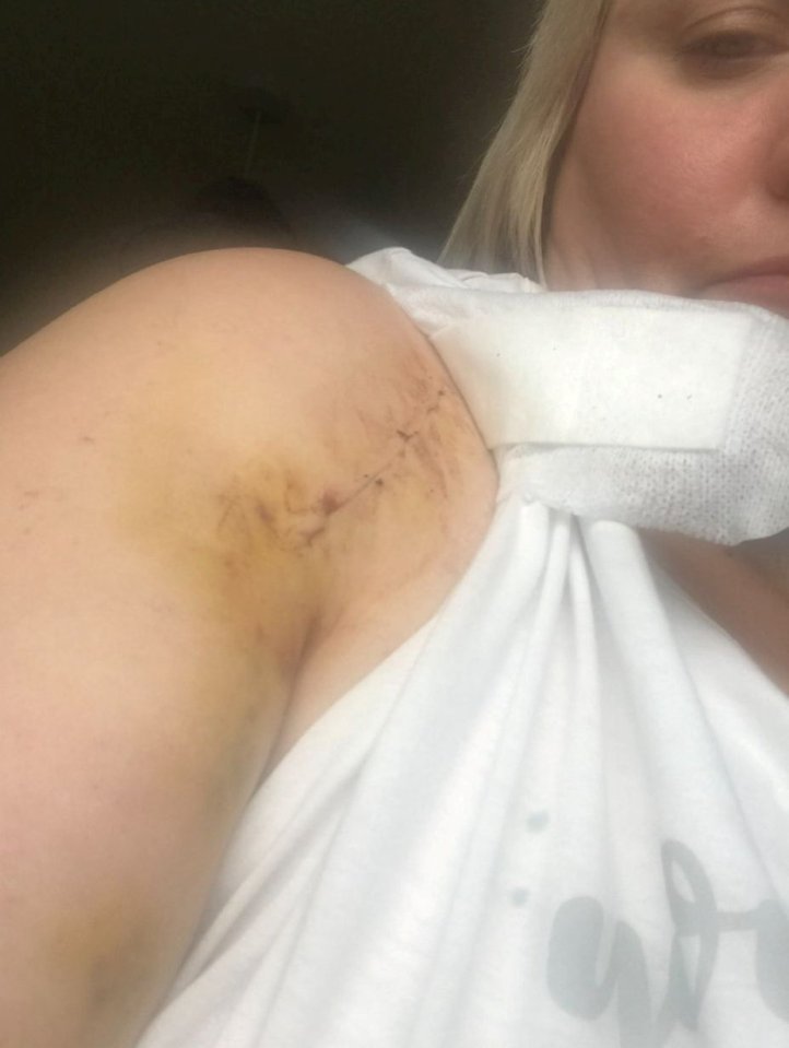 Woman's shoulder with surgical scar and bandage.