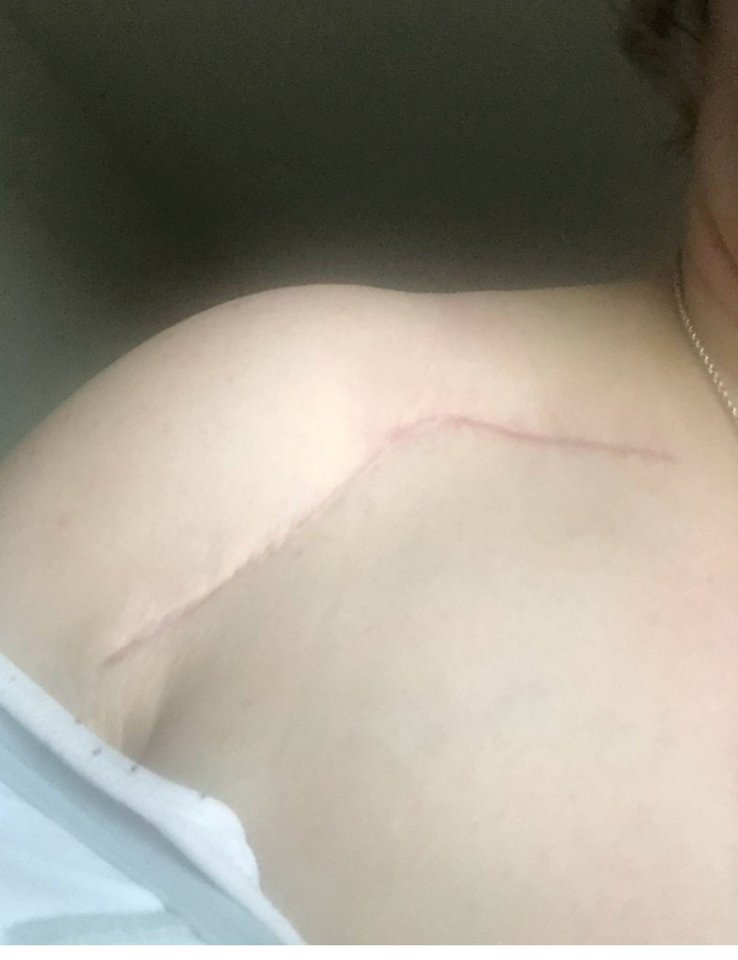 Scar on a woman's shoulder.