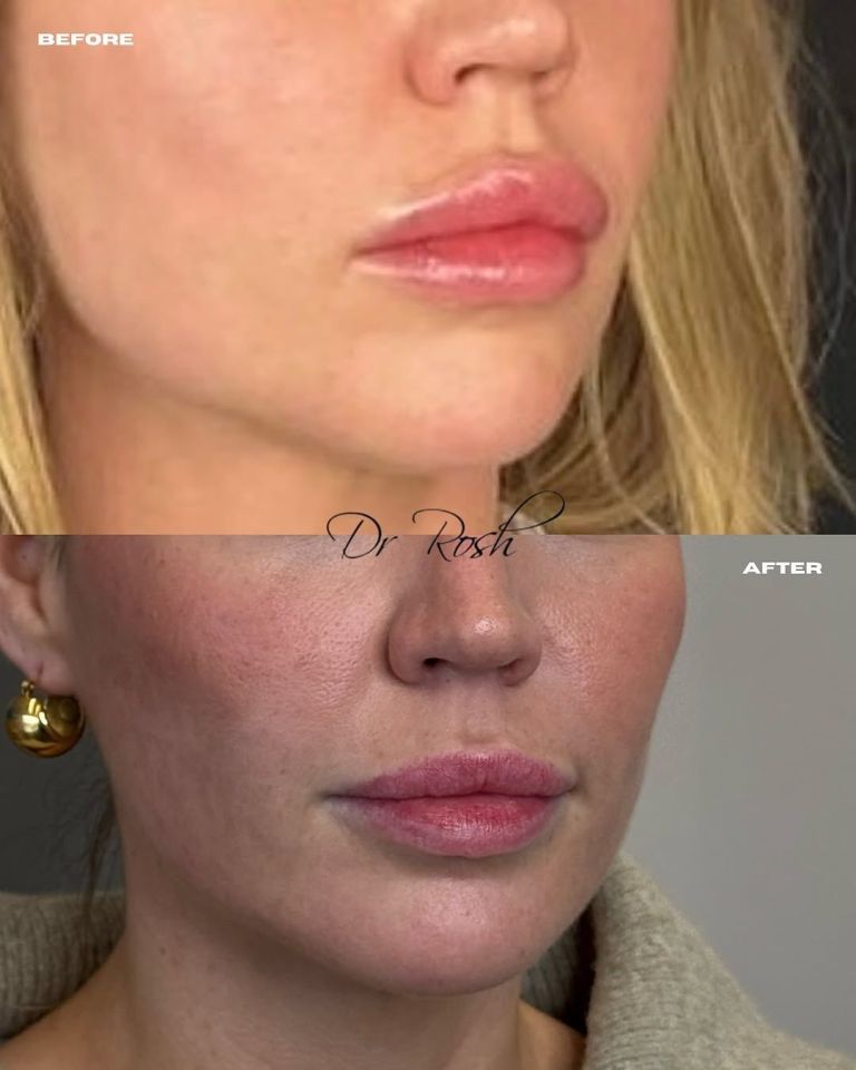 Before and after photos of lip filler dissolution.