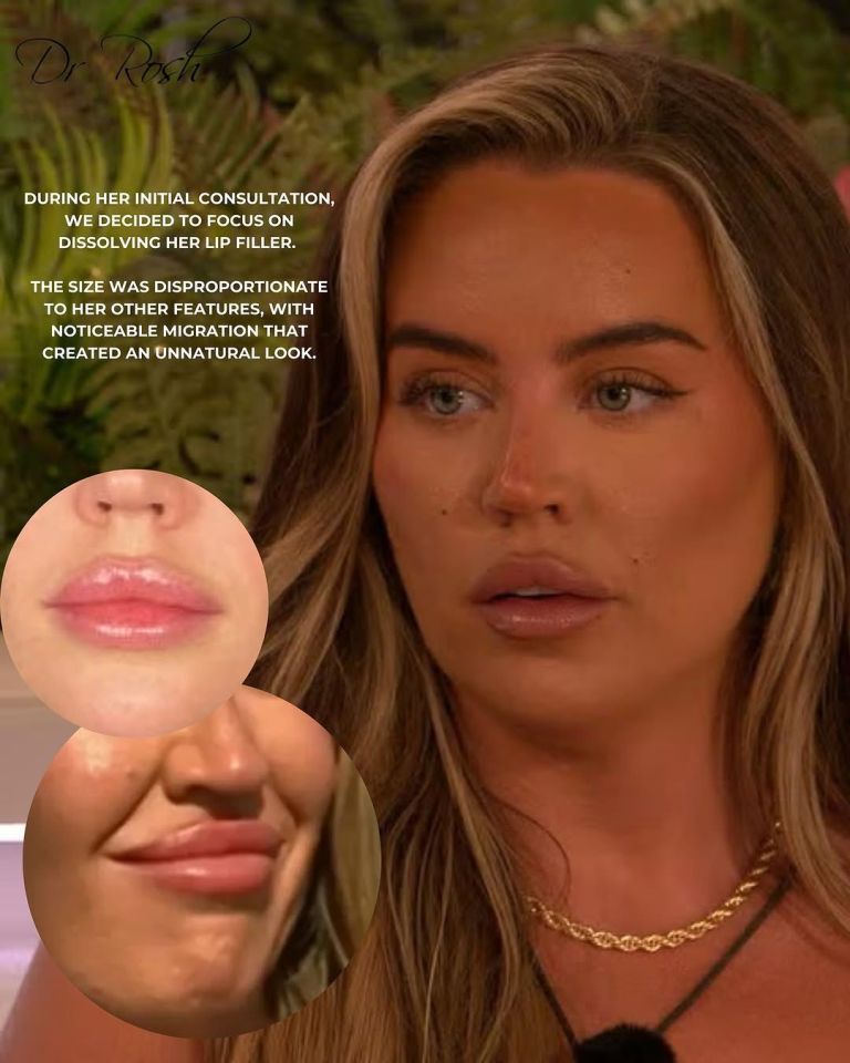 Before and after photos of Samantha Kenny's lip filler being dissolved.