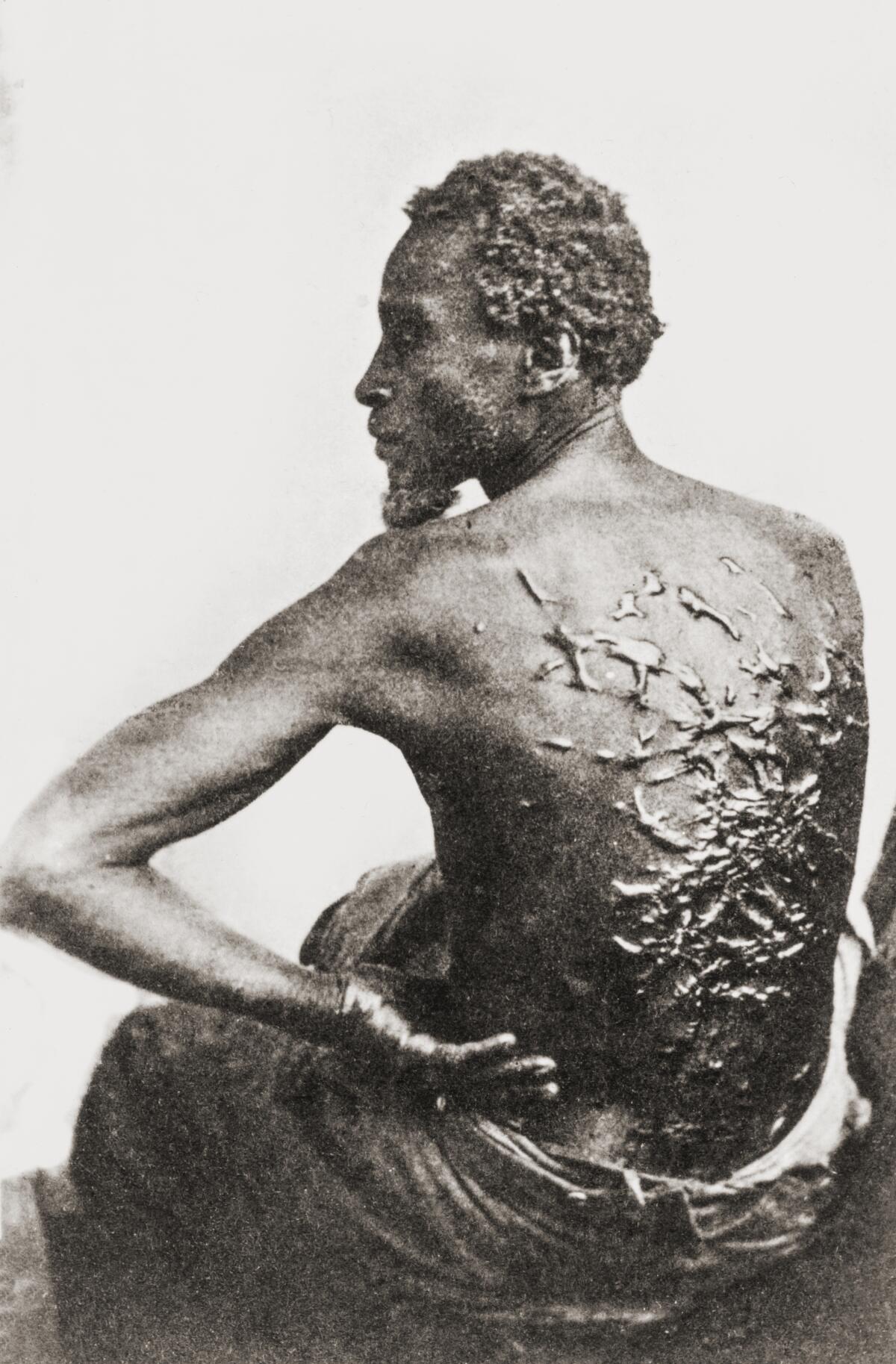The scarred back of a slave who escaped from Mississippi and reached a Union Army camp in Louisiana in 1863. 